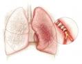 Тамака-шваса-бронхиальная астма. Этиология,патогенез,терапия