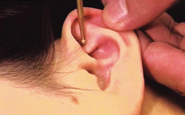 Точечный массаж ушных раковин